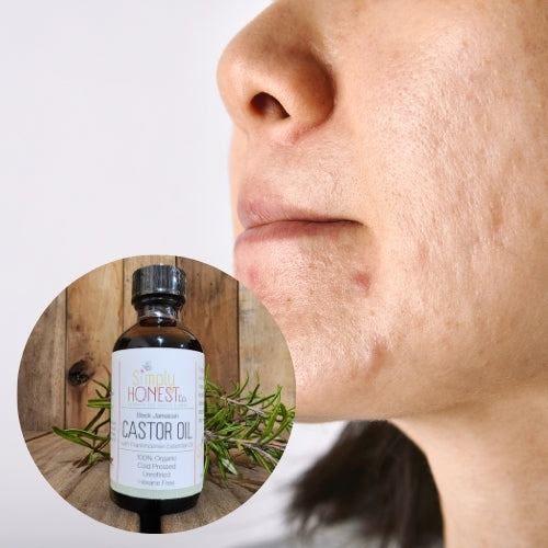 Castor Oil for Facial Scars and Hyperpigmentation